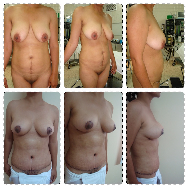 Tummy Tuck + Liposuction + Breast Lift